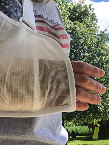 Broken arm